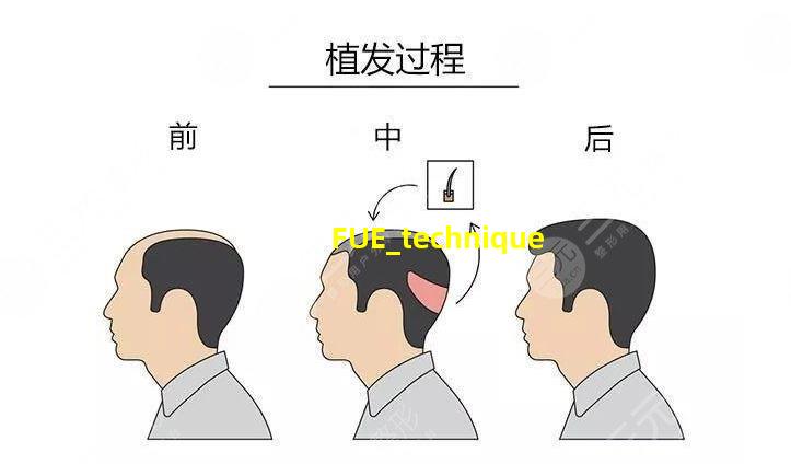 FUE技术演示图片