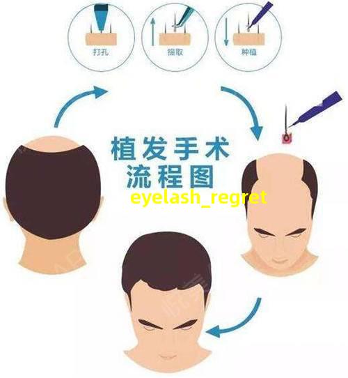 种植睫毛手shu后悔的图片