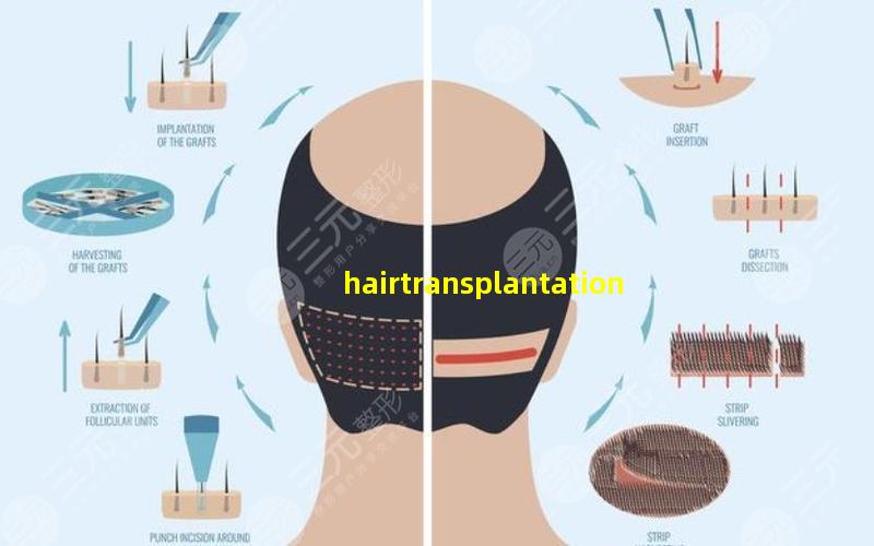 hair transplantation