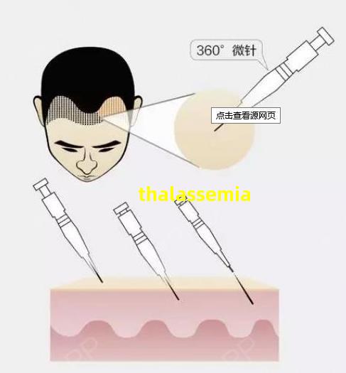 thalassemia