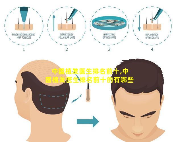 中国植发医生排名前十,中国植发医生排名前十的有哪些