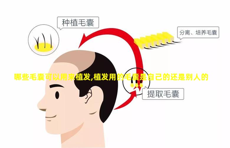 哪些毛囊可以用来植发,植发用的毛囊是自己的还是别人的