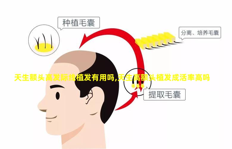 天生额头高发际线植发有用吗,天生高额头植发成活率高吗