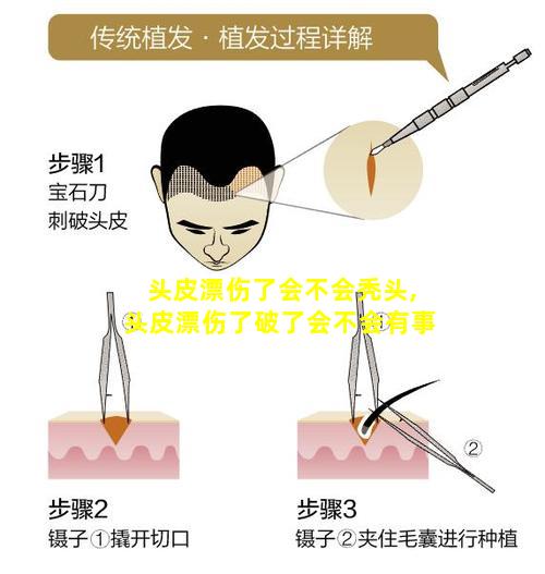 头皮漂伤了会不会秃头,头皮漂伤了破了会不会有事