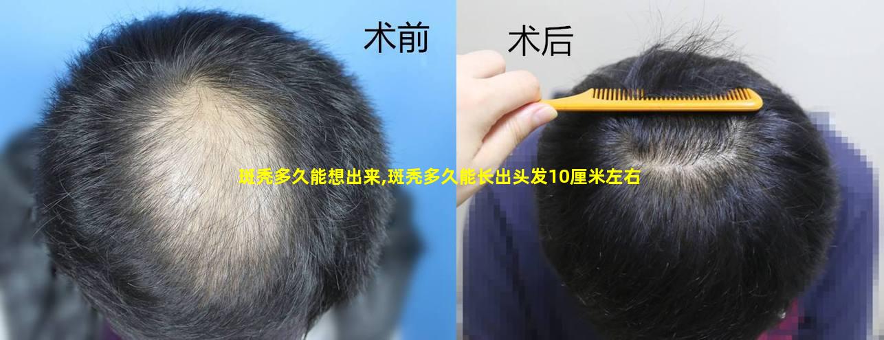 斑秃多久能想出来,斑秃多久能长出头发10厘米左右