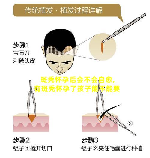 斑秃怀孕后会不会自愈,有斑秃怀孕了孩子能不能要