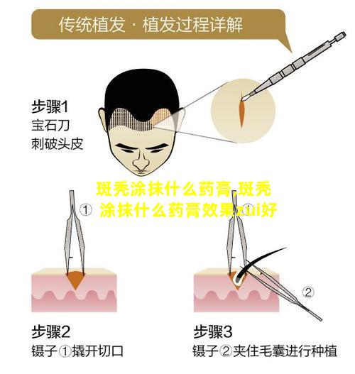 斑秃涂抹什么药膏,斑秃涂抹什么药膏效果zui好