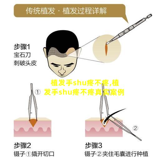 植发手shu疼不疼,植发手shu疼不疼真实案例