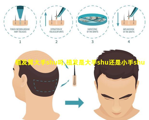 植发算大手shu吗,植发是大手shu还是小手shu