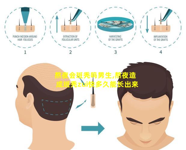 熬夜会斑秃吗男生,熬夜造成斑秃zui快多久能长出来