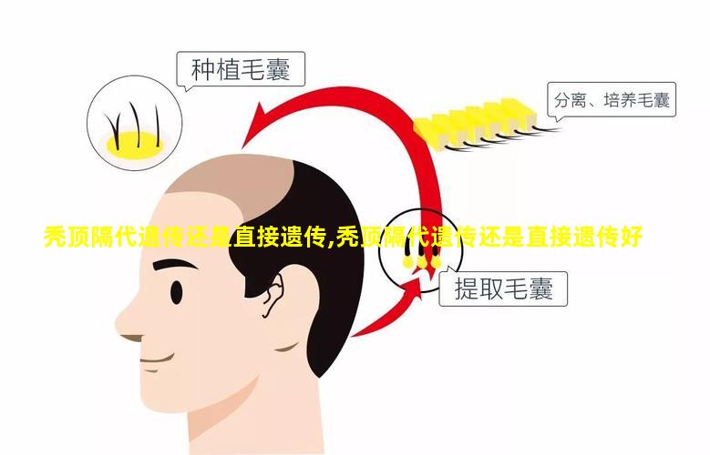 秃顶隔代遗传还是直接遗传,秃顶隔代遗传还是直接遗传好