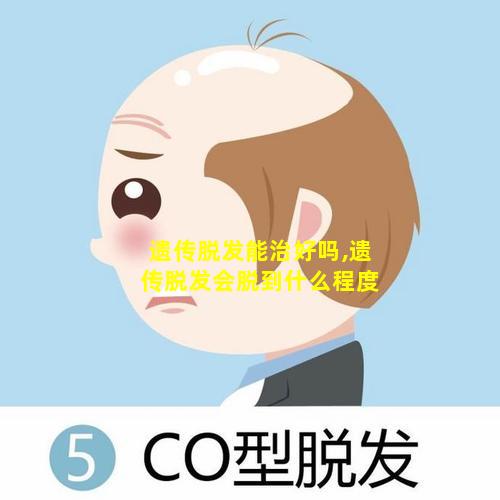 遗传脱发能治好吗,遗传脱发会脱到什么程度