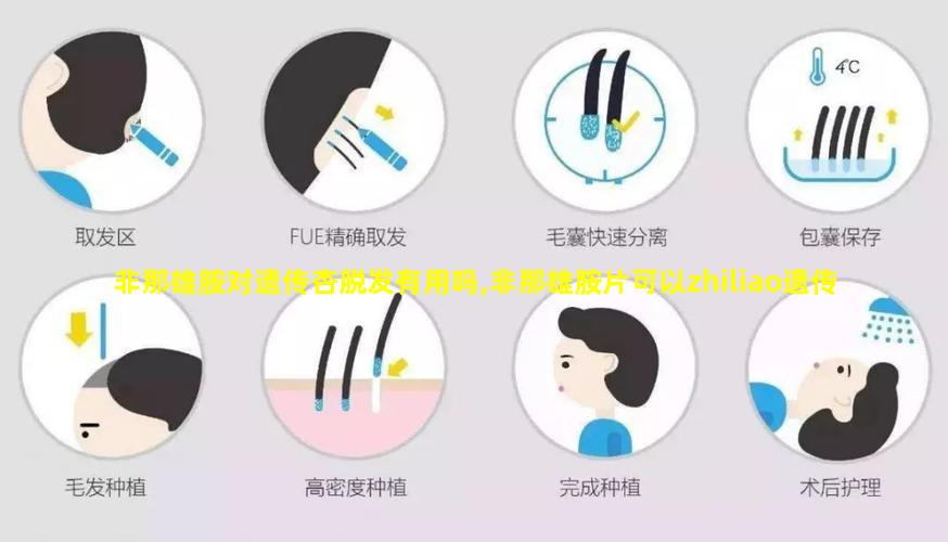 非那雄胺对遗传杏脱发有用吗,非那雄胺片可以zhiliao遗传杏脱发吗